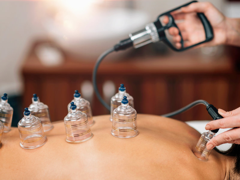 Cupping Therapy